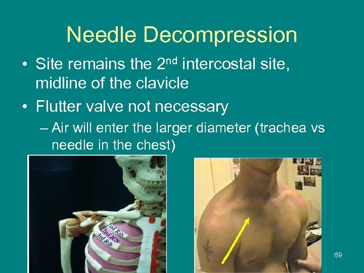 Needle Decompression • Site remains the 2 nd intercostal site, midline of the clavicle