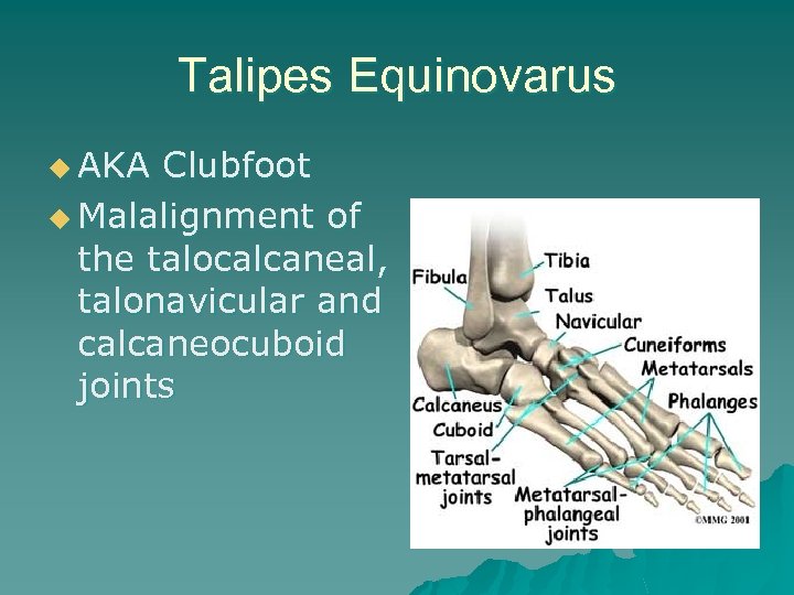 Talipes Equinovarus u AKA Clubfoot u Malalignment of the talocalcaneal, talonavicular and calcaneocuboid joints