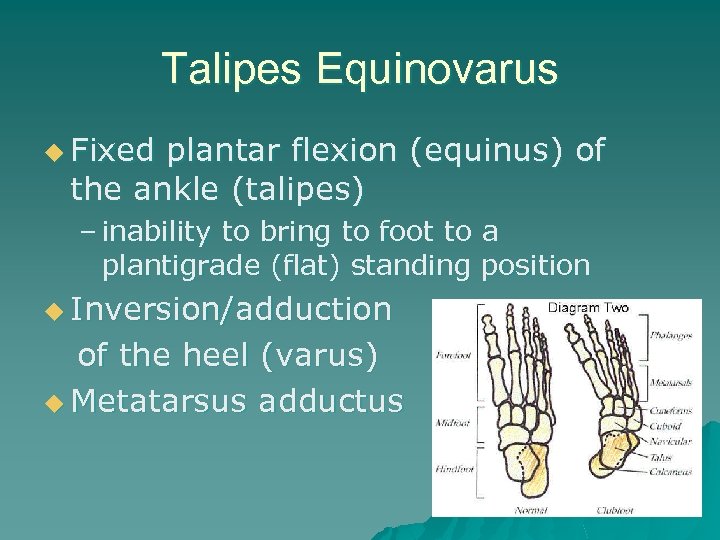 Talipes Equinovarus u Fixed plantar flexion (equinus) of the ankle (talipes) – inability to