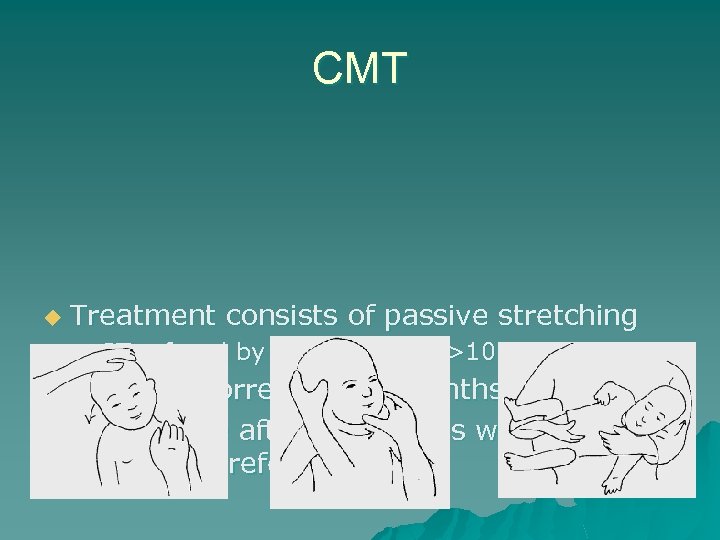 CMT u Treatment consists of passive stretching – PT referral by 2 -3 months