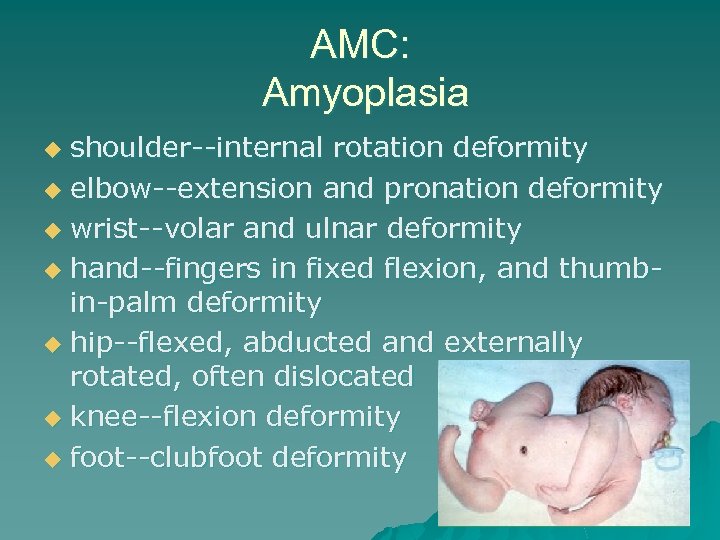 AMC: Amyoplasia shoulder--internal rotation deformity u elbow--extension and pronation deformity u wrist--volar and ulnar