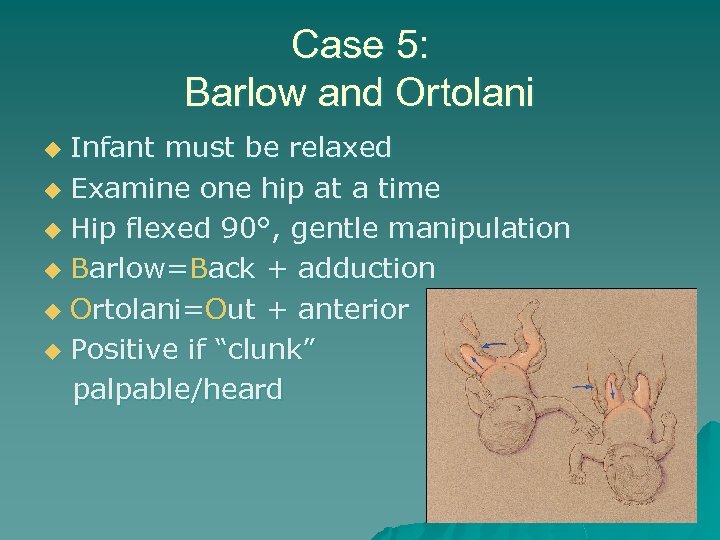 Case 5: Barlow and Ortolani Infant must be relaxed u Examine one hip at
