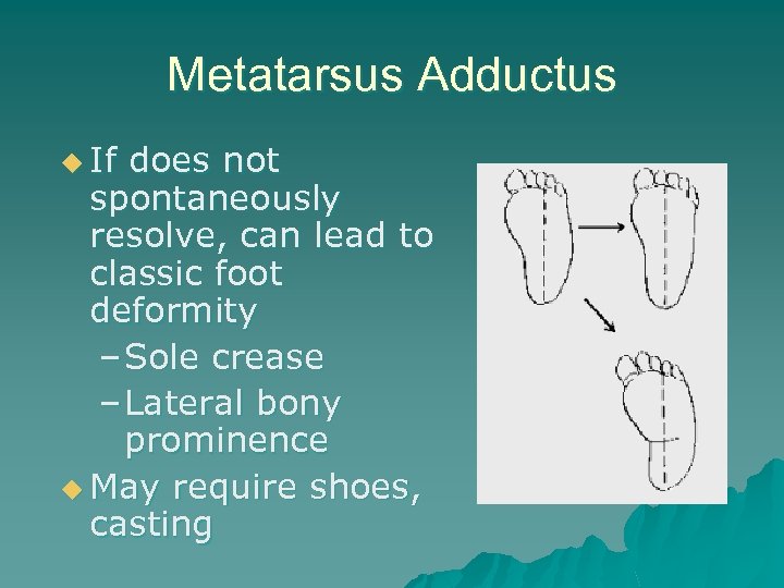 Metatarsus Adductus u If does not spontaneously resolve, can lead to classic foot deformity