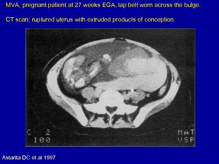 MVA, pregnant patient at 27 weeks EGA, lap belt worn across the bulge. CT