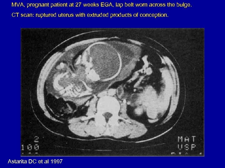 MVA, pregnant patient at 27 weeks EGA, lap belt worn across the bulge. CT