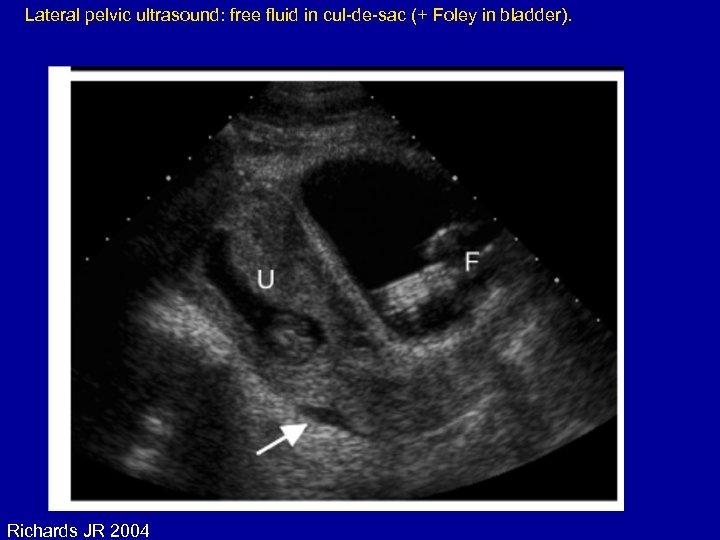 Lateral pelvic ultrasound: free fluid in cul-de-sac (+ Foley in bladder). Richards JR 2004