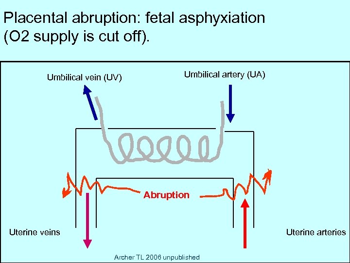 Placental abruption: fetal asphyxiation ) (O 2 supply is cut off). Umbilical vein (UV)