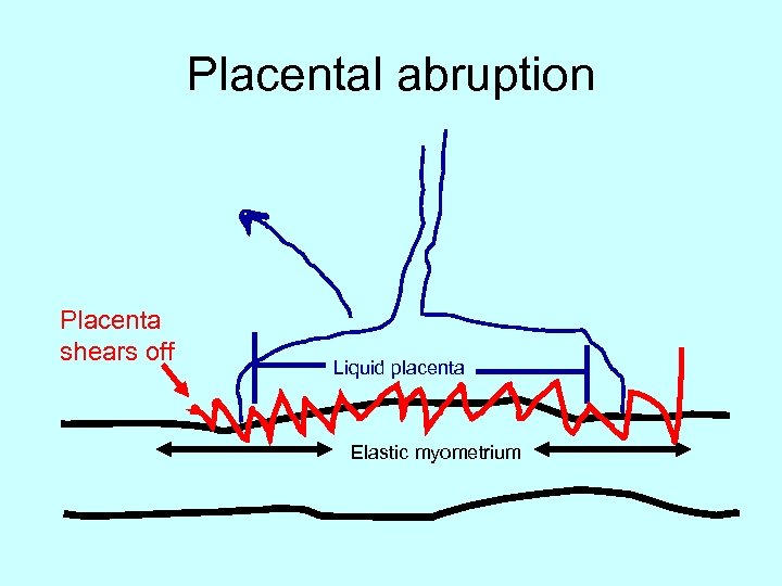 Placental abruption Placenta shears off Liquid placenta Elastic myometrium 