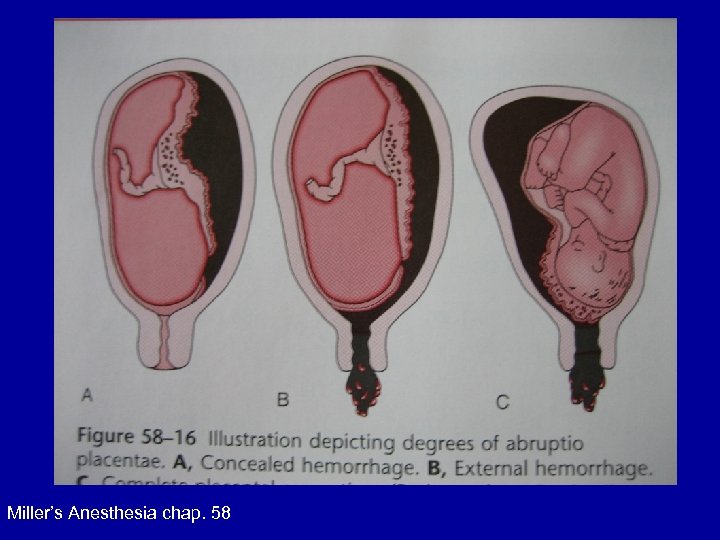 Miller’s Anesthesia chap. 58 