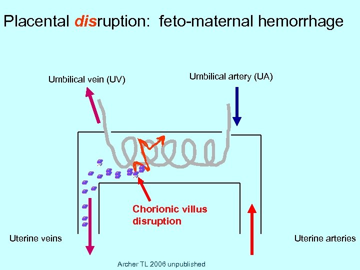 ) Placental disruption: feto-maternal hemorrhage Umbilical vein (UV) Umbilical artery (UA) Chorionic villus disruption