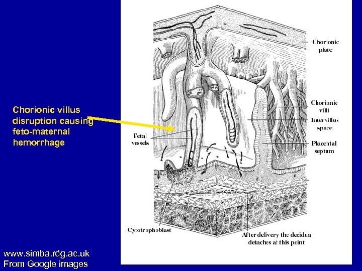 Chorionic villus disruption causing feto-maternal hemorrhage www. simba. rdg. ac. uk From Google images