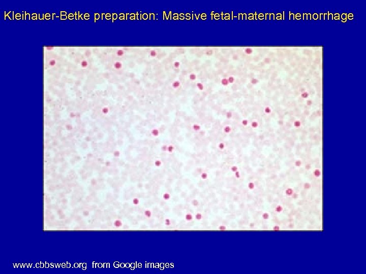 Kleihauer-Betke preparation: Massive fetal-maternal hemorrhage www. cbbsweb. org from Google images 