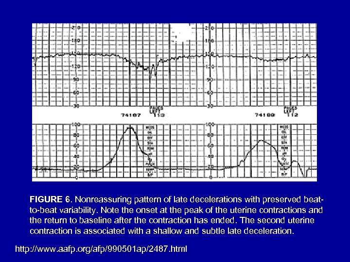 FIGURE 6. Nonreassuring pattern of late decelerations with preserved beatto-beat variability. Note the onset