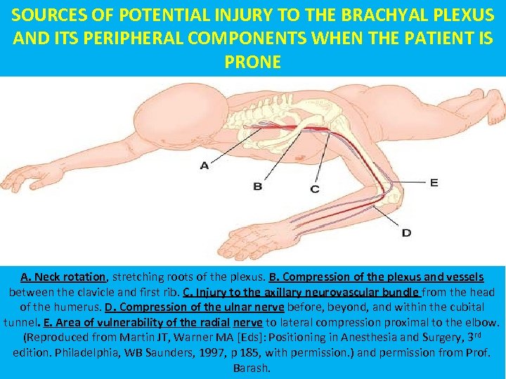 SOURCES OF POTENTIAL INJURY TO THE BRACHYAL PLEXUS AND ITS PERIPHERAL COMPONENTS WHEN THE