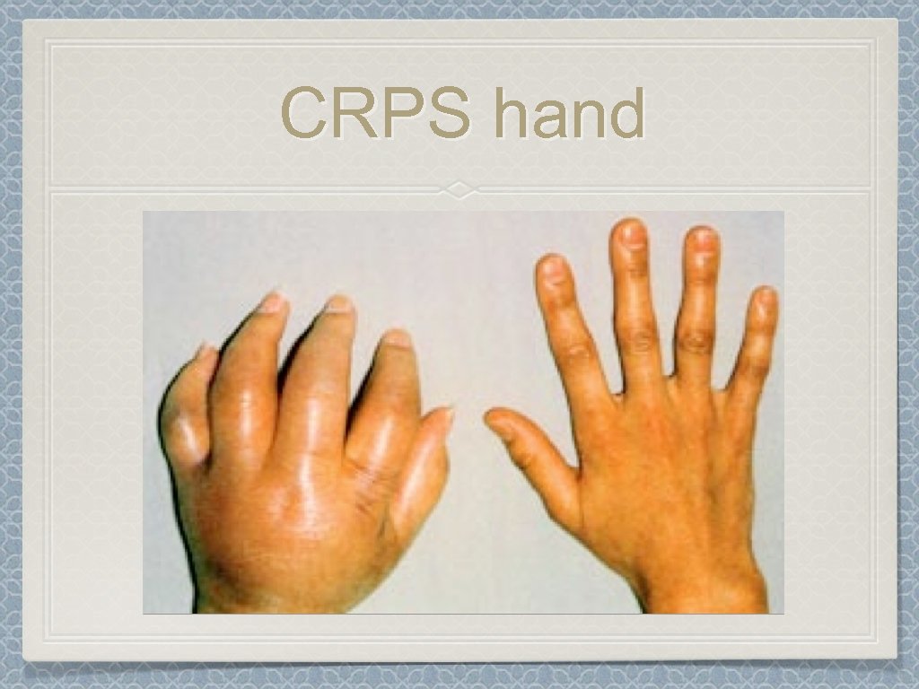 CRPS hand 