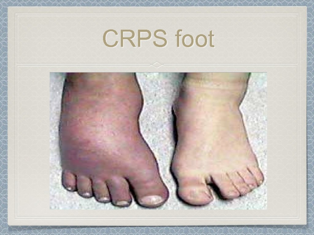 CRPS foot 