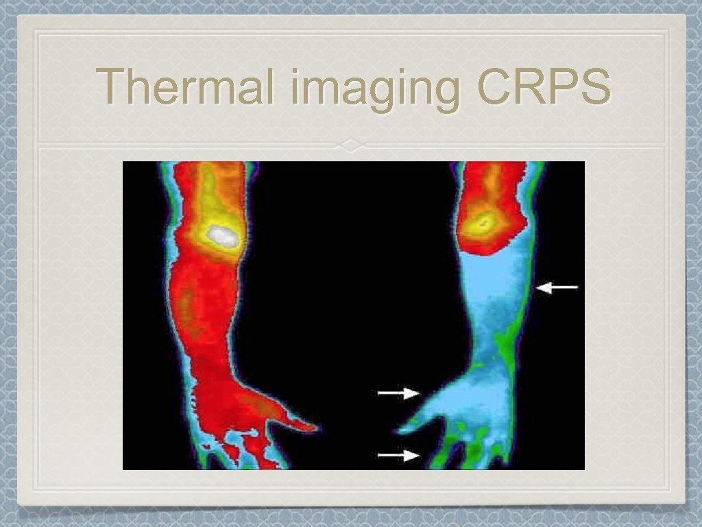 Thermal imaging CRPS 