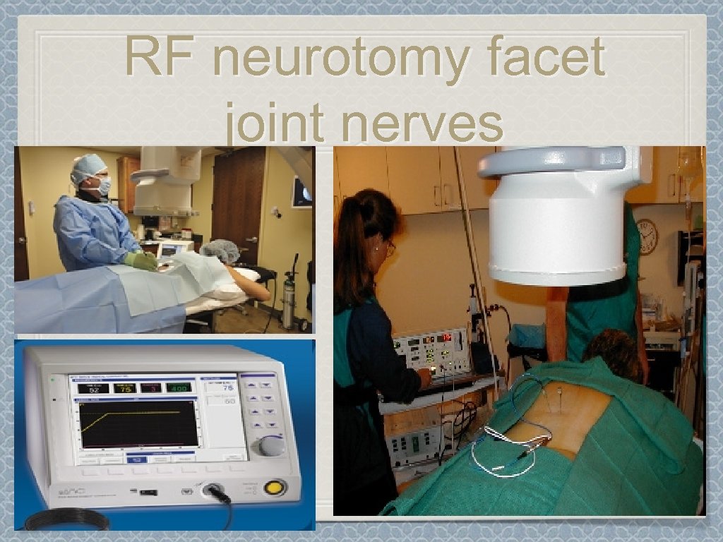 RF neurotomy facet joint nerves 