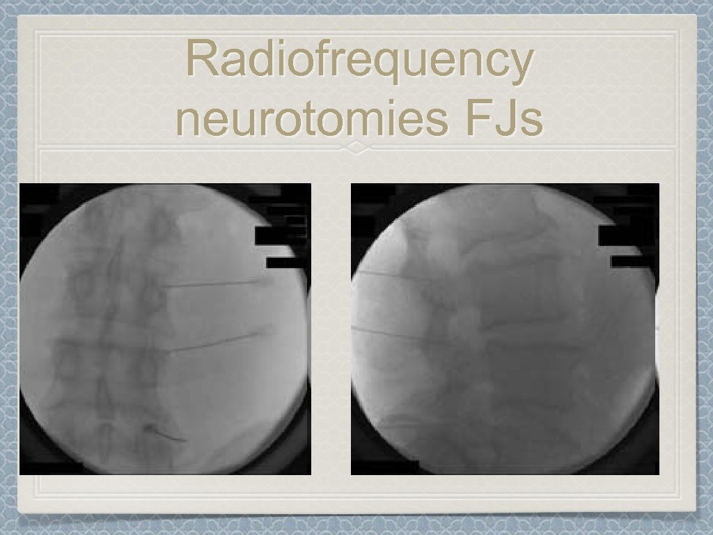 Radiofrequency neurotomies FJs 