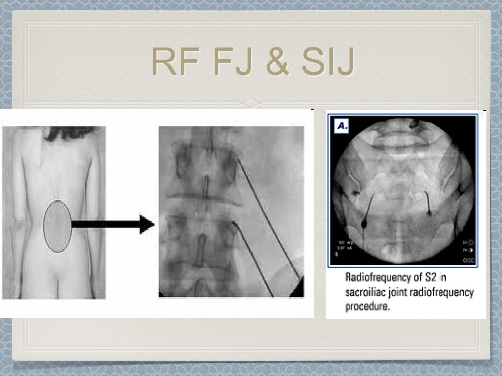 RF FJ & SIJ 