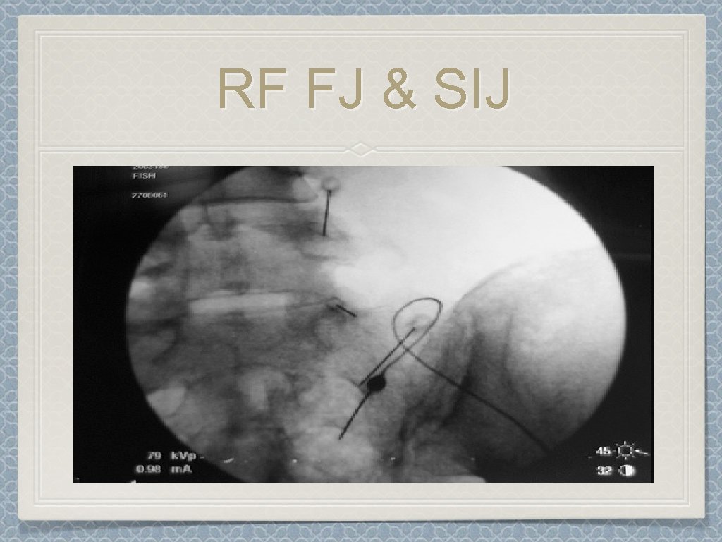 RF FJ & SIJ 