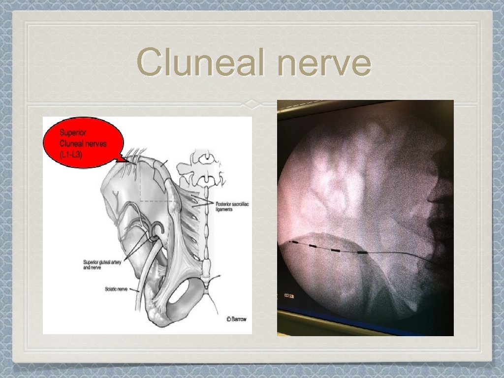 Cluneal nerve 