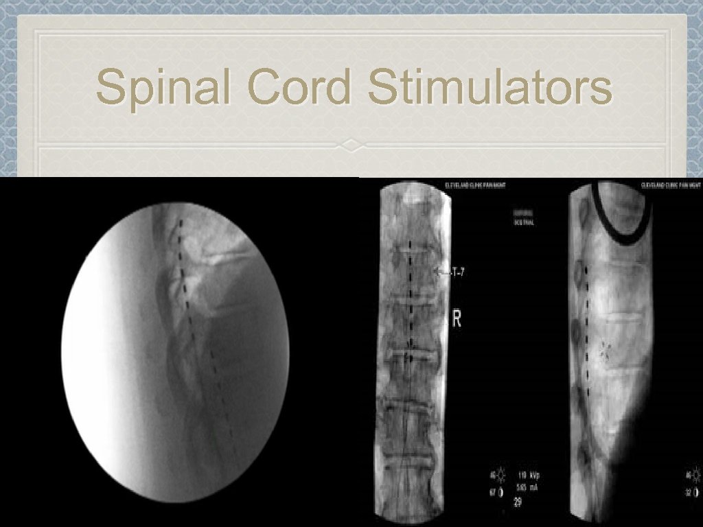 Spinal Cord Stimulators 