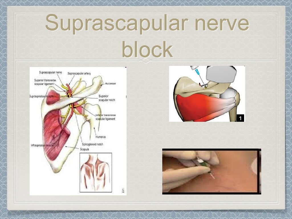 Suprascapular nerve block 