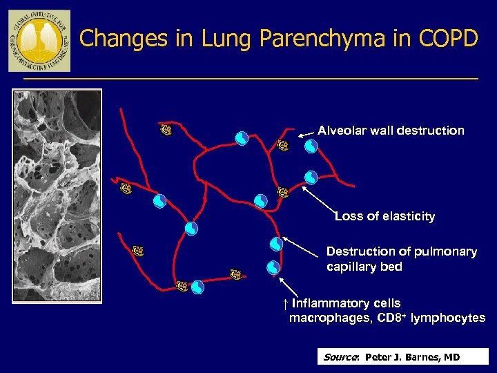 Changes in Lung Parenchyma in COPD Alveolar wall destruction Loss of elasticity Destruction of