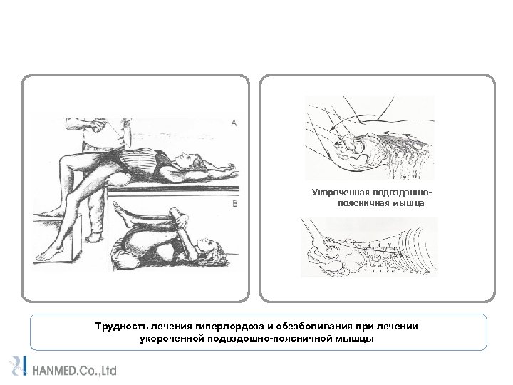 Укороченная подвздошнопоясничная мышца Трудность лечения гиперлордоза и обезболивания при лечении укороченной подвздошно-поясничной мышцы 