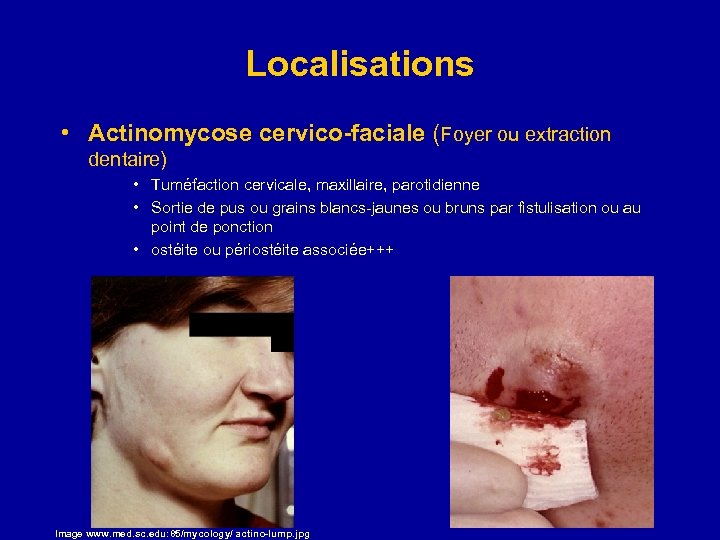 Localisations • Actinomycose cervico-faciale (Foyer ou extraction dentaire) • Tuméfaction cervicale, maxillaire, parotidienne •