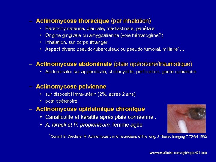 – Actinomycose thoracique (par inhalation) • • Parenchymateuse, pleurale, médiastinale, pariétale Origine gingivale ou