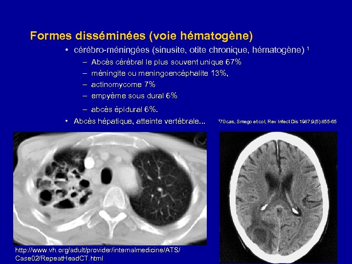 Formes disséminées (voie hématogène) • cérébro-méningées (sinusite, otite chronique, hématogène) 1 – – Abcès