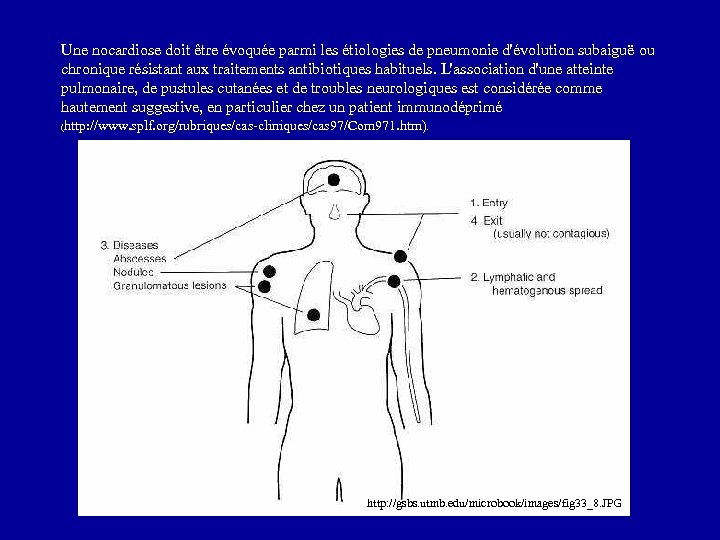 Une nocardiose doit être évoquée parmi les étiologies de pneumonie d'évolution subaiguë ou chronique