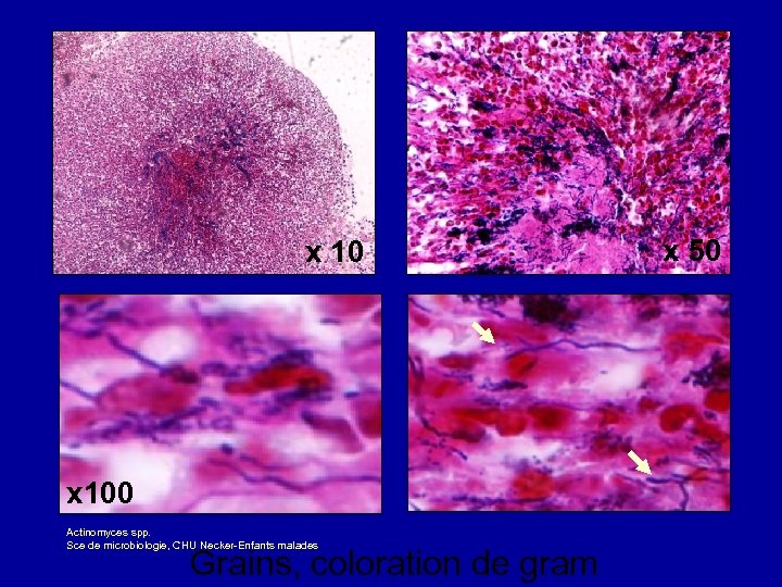 x 100 Actinomyces spp. Sce de microbiologie, CHU Necker-Enfants malades Grains, coloration de gram