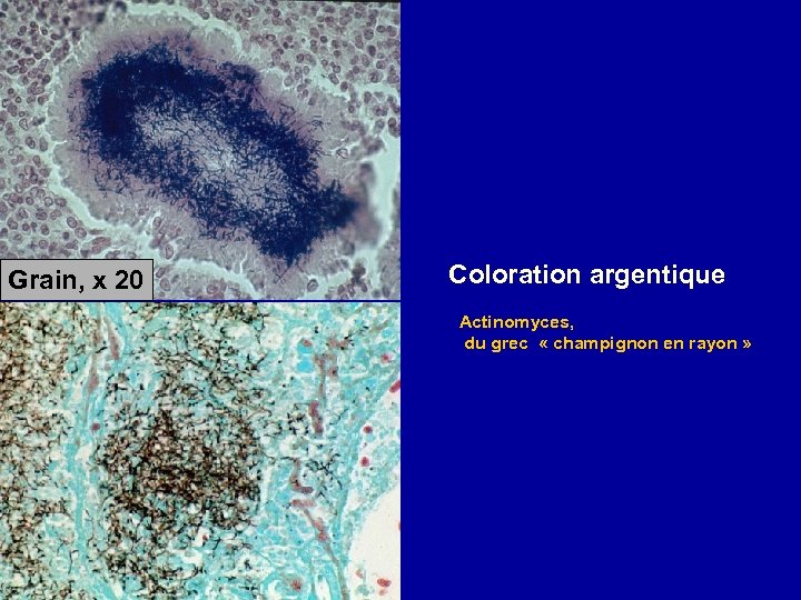 Grain, x 20 Coloration argentique Actinomyces, du grec « champignon en rayon » 