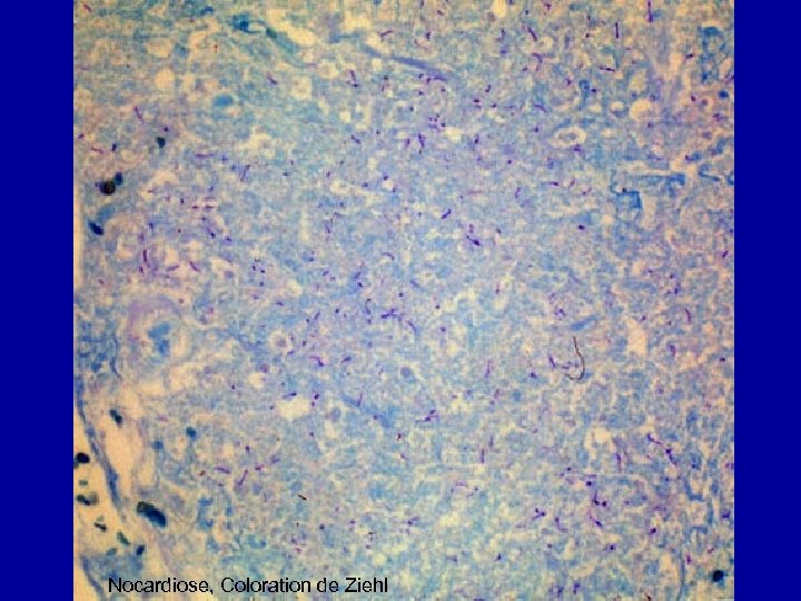 Nocardiose, Coloration de Ziehl 