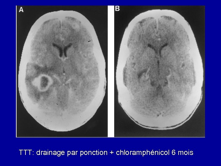 TTT: drainage par ponction + chloramphénicol 6 mois 