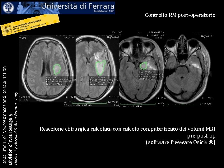 University-Hospital S. Anna Ferrara - Italy Department of Neurosciences and Rehabilitation Division of Neurosurgery