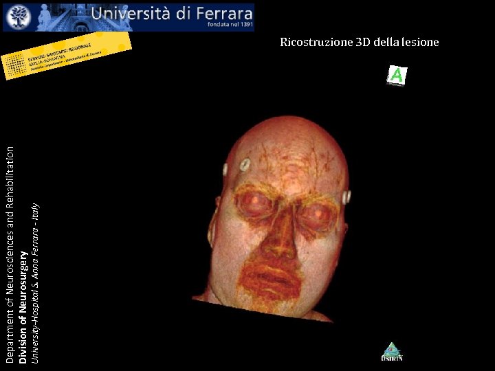 University-Hospital S. Anna Ferrara - Italy Department of Neurosciences and Rehabilitation Division of Neurosurgery