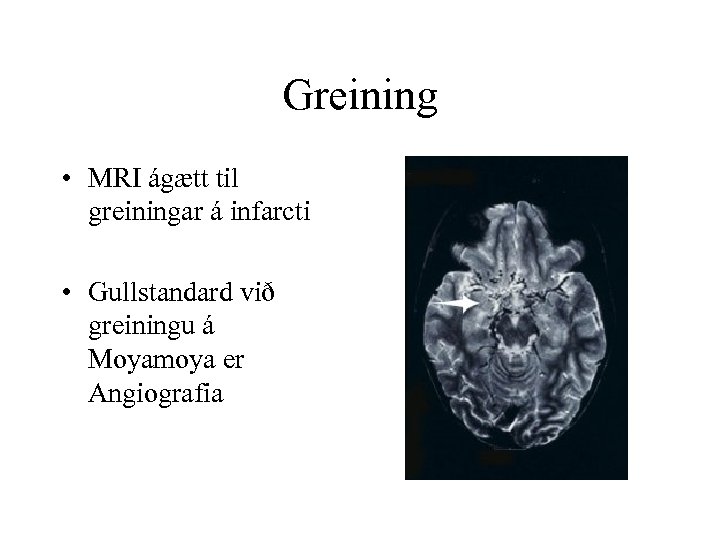 Greining • MRI ágætt til greiningar á infarcti • Gullstandard við greiningu á Moyamoya