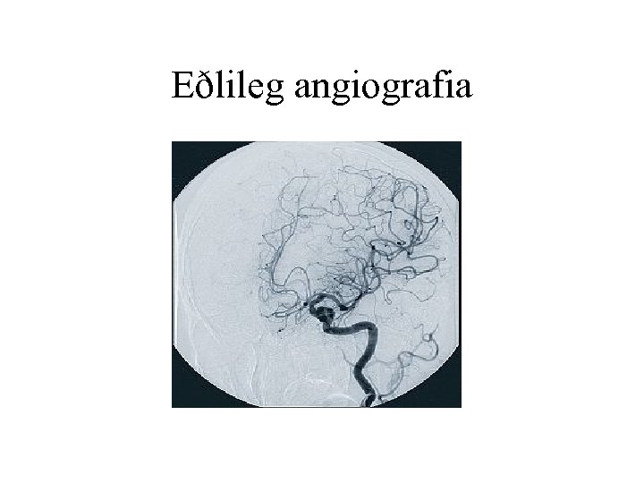 Eðlileg angiografia 