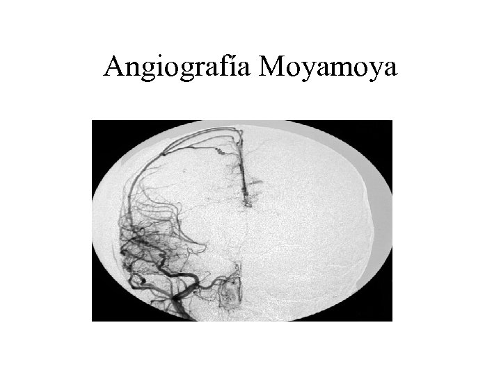 Angiografía Moyamoya 