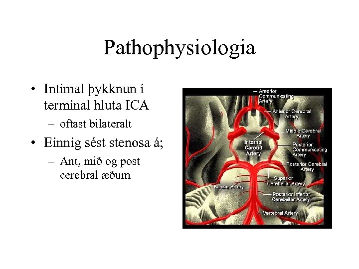 Pathophysiologia • Intimal þykknun í terminal hluta ICA – oftast bilateralt • Einnig sést