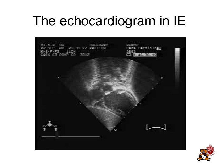 The echocardiogram in IE 