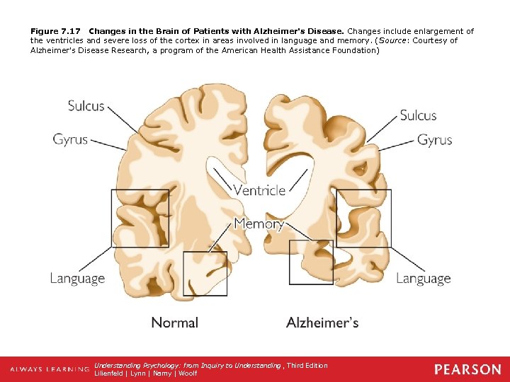 Figure 7. 17 Changes in the Brain of Patients with Alzheimer's Disease. Changes include