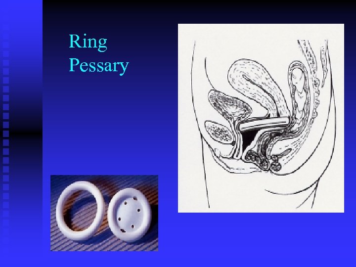 Ring Pessary 