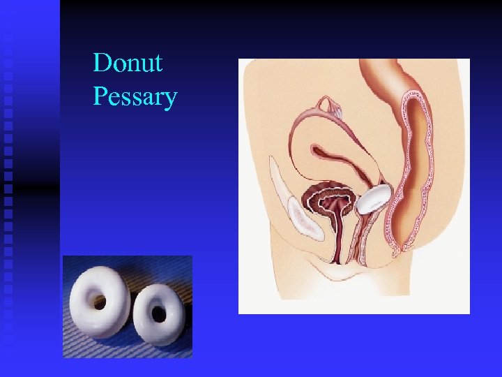 Donut Pessary 