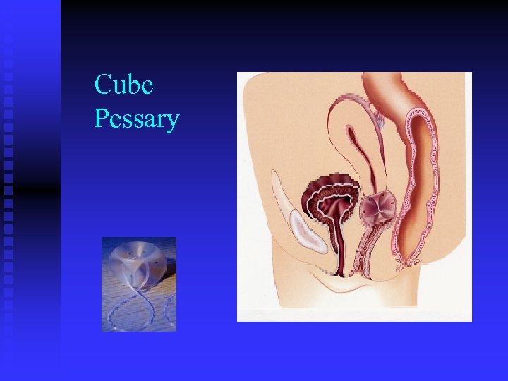 Cube Pessary 