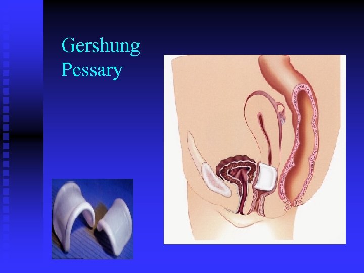 Gershung Pessary 